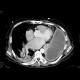 Empyema of the thorax: CT - Computed tomography